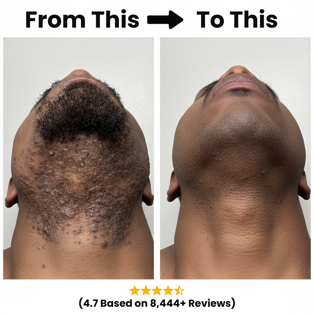 Razor Bump & Ingrown Hair Treatment