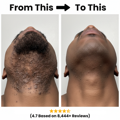 Razor Bump & Ingrown Hair Treatment