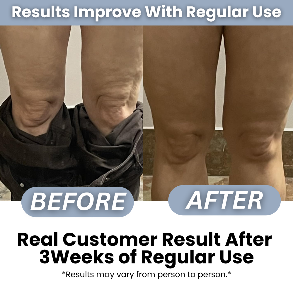 Anti-Cellulite Massage Roller